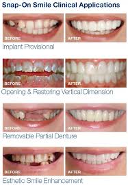 Snapon Smile/ veeners/ snap on smile veerners / veeners braces/ silicon braces/ Artificial teeth